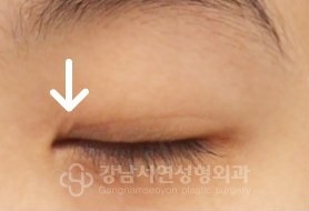 안쪽 선 변환 BEFORE