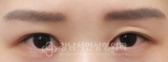 IN라인 → IN-OUT 변환 수술 전