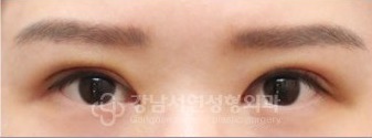 IN라인 → IN-OUT 변환 수술 후 7일