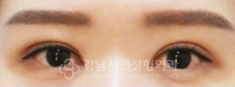 IN라인 → IN-OUT 변환 수술 후 1개월