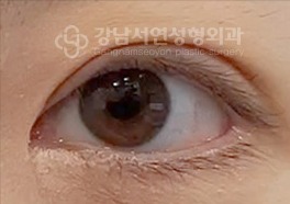 재수술 후 유착으로 생긴 악성 겹주름 — 수술 후