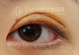 재수술 후 유착으로 생긴 악성 겹주름 — 수술 전
