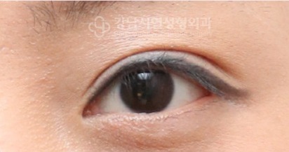 눈매교정이 풀리면서 쌍꺼풀이 풀린 악성 겹주름 — 수술 후