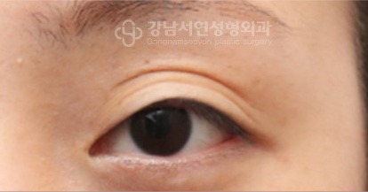 눈매교정이 풀리면서 쌍꺼풀이 풀린 악성 겹주름 — 수술 전