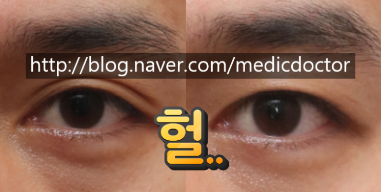 쌍꺼풀 없애는 수술 쌍꺼풀 없애는 법 무쌍 눈매교정 부작용