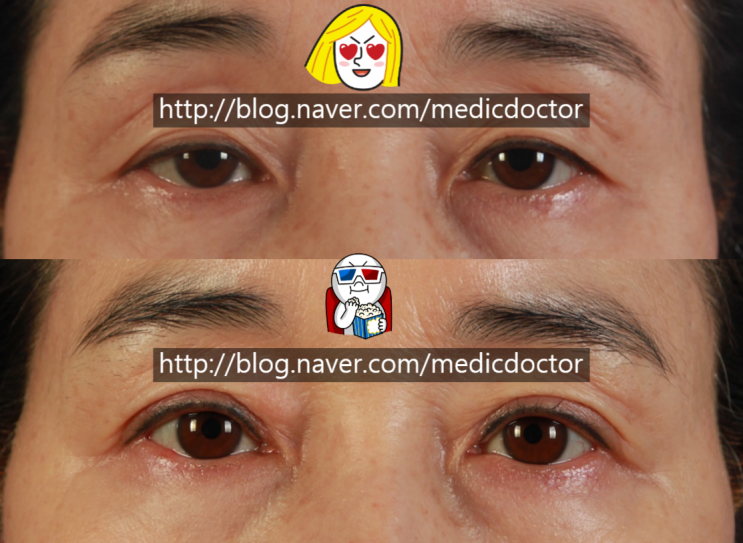 상안검 수술 중년 쌍꺼풀 수술 처진 눈꺼풀