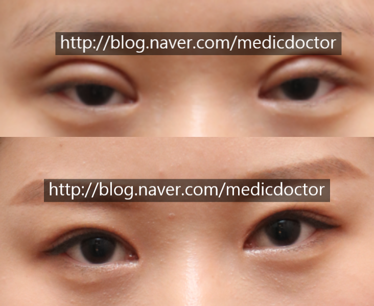 쌍꺼풀 부작용 안전한 절개 쌍꺼풀 수술
