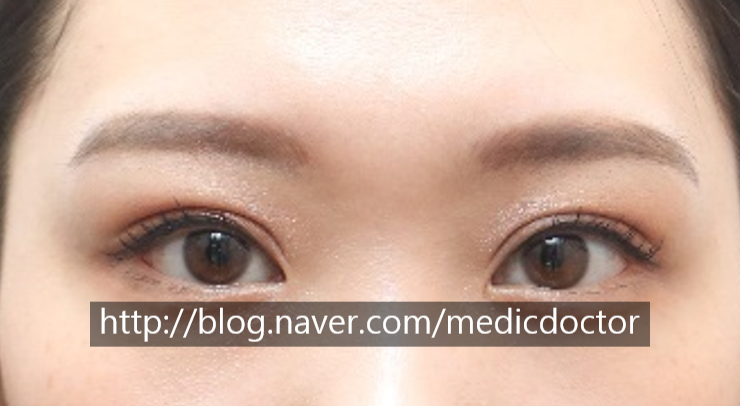 쌍커플 쌍커풀 쌍꺼풀 쌍꺼플 수술 인아웃 아웃
