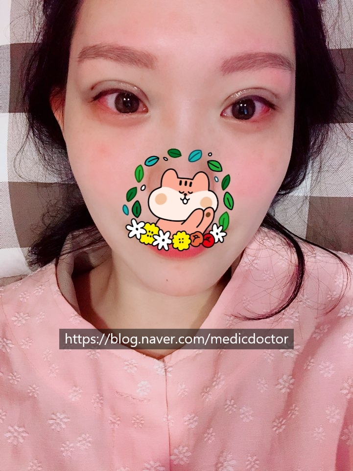 쌍수 후기 광고 아님 - 이 진짜 광고 아닐까?