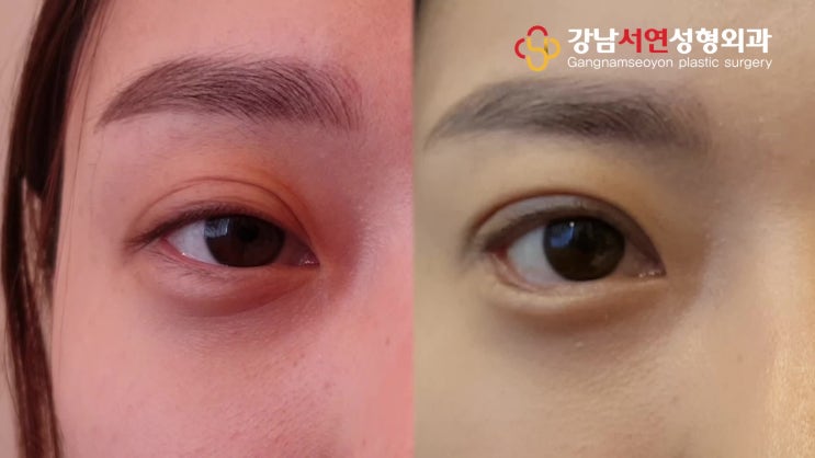 갤럭시 노트 성형외과 수술 촬영에 일품!!