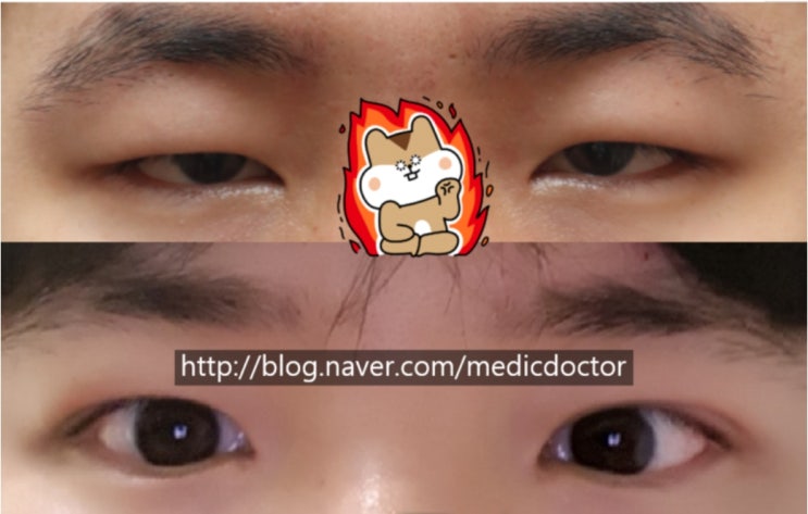 남자 무쌍 눈매교정에 대해서 - 개인적 견해
