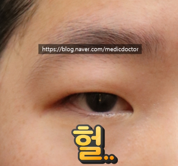 눈매교정눈두덩이 두꺼워짐 해결방법