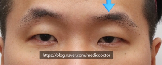 눈비대칭 일때 눈 짝짝이 교정하는 방법