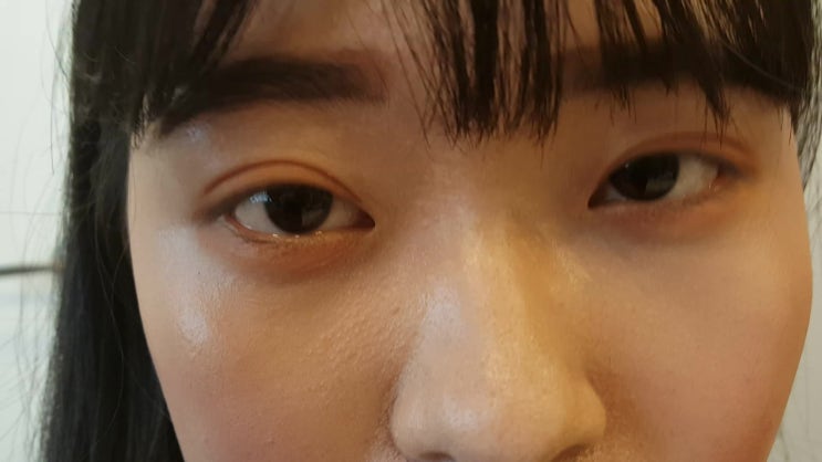 절개눈매교정 수술 쌍꺼풀 흉터 많이 남나요?