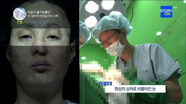 렛미인 성형외과 의사로 출연 했을 때 - 눈성형 쌍꺼풀