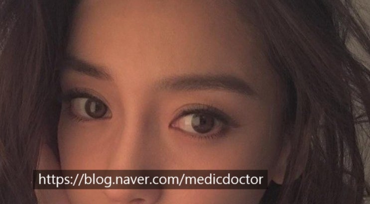 자연스러운 아웃라인 쌍꺼풀 만들기 발표 ㅡ 아시안 눈성형포럼 2019