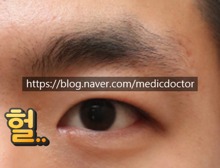 남자 눈매교정 붓기 1주일, 1개월 동영상