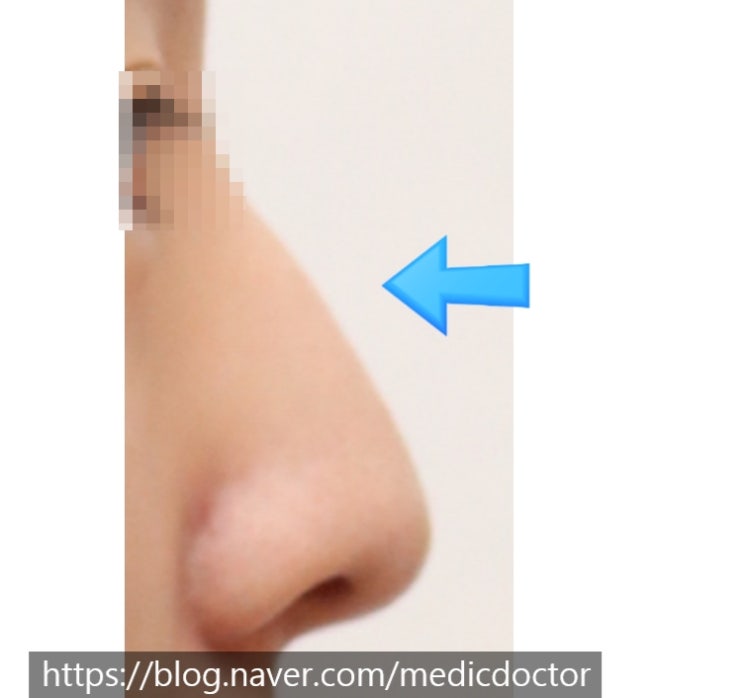 매부리코 수술 - 보형물 없는 코 수술