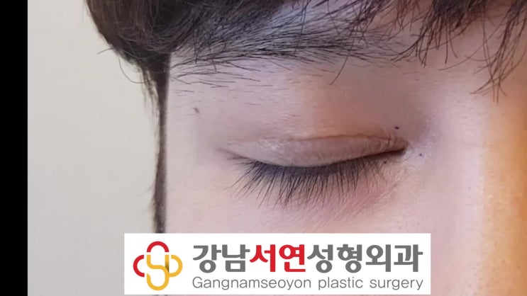 남자무쌍눈매교정과 앞트임복원  치험례