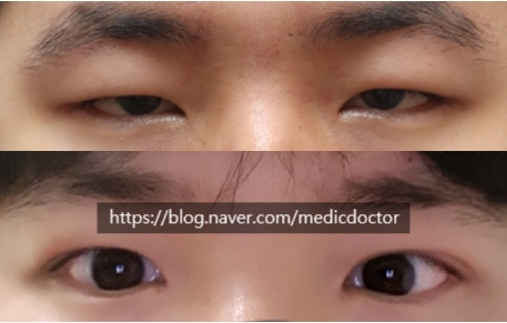 비절개 눈매교정 부작용. 매몰법 하면 안되는 케이스