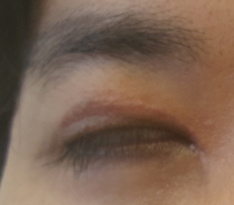 남자 무쌍 눈매교정 부작용 겪는 분들 연락주세요