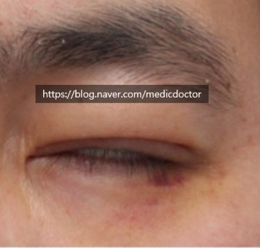 안검하수 개선을 위한 눈매교정술 후 부작용 해결법(신문기사)
