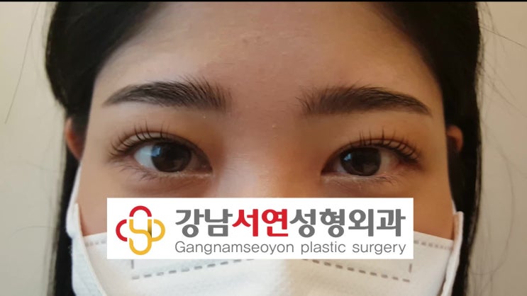 짝눈 교정 후기 - 원리 이해 - 가격이 중요하지 않아요