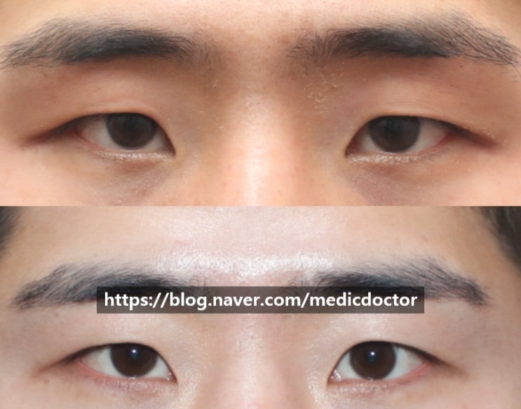 이마로 눈뜨기 - 남자 무쌍 눈매교정 으로 해결