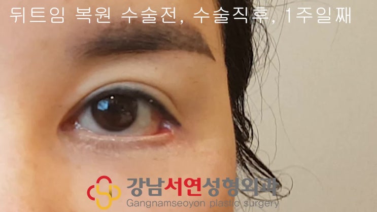 뒤트임 복원, 뒤트임 재건, 뒤트임재수술, 수술전, 수술직후, 수술1주일 경과