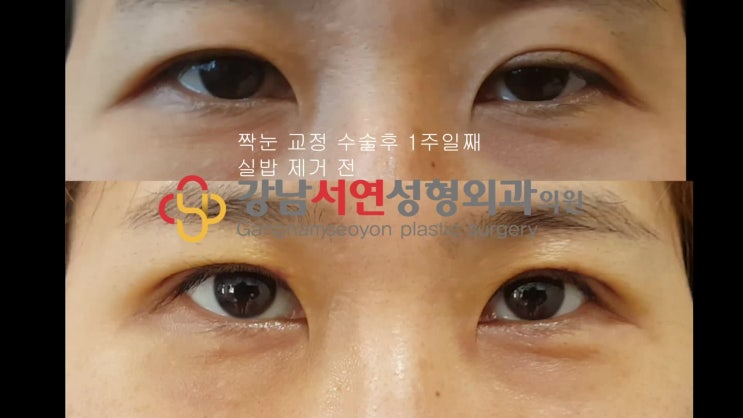 짝눈 교정 , 한쪽 눈 졸려 보이는  경우 절개 눈매교정 으로 수술