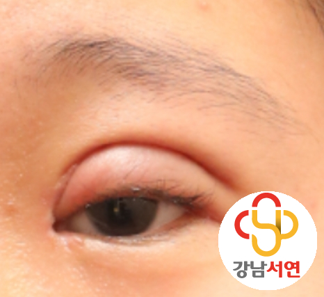 한줄따기 두줄따기 쌍꺼풀 재수술 두줄띠응애