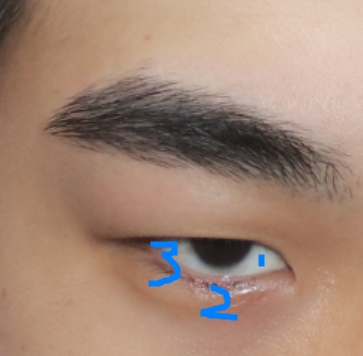 남자무쌍눈매교정 수술전과 직후 수술 당일 촬영 (feat. 삼백안교정)