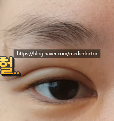소세지 쌍수 풀기 (비절개 실제거)