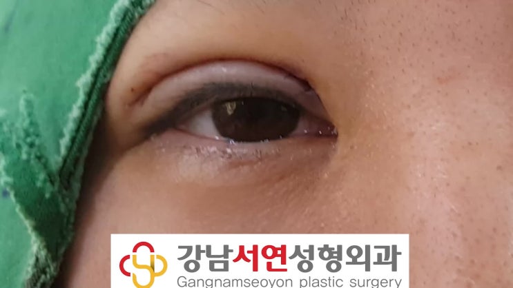 두줄따기 수술 소세지 쌍꺼풀 낮춘 3개월 흉터 증례