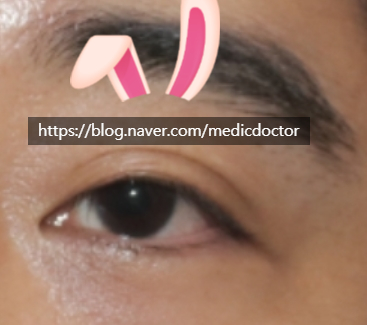 남자쌍꺼풀 없애기 수술 치험례 쌍꺼풀제거 수술