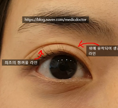 두줄따기 라인 겹주름 (삼겹쌍꺼풀)정리하기 수술전, 수술직후, 1주일 경과 동영상 후기