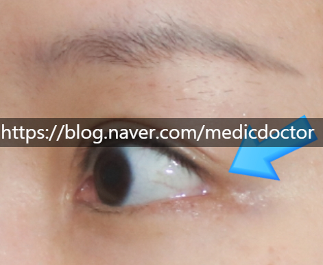 뒤트임 재건, 뒷트임 재건 1주일째 치험례