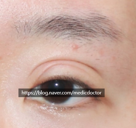 쌍꺼풀 풀림으로 인한 여러겹 쌍꺼풀이 생긴 삼중 쌍꺼풀 에서 여러 라인을 하나의 라인으로 교정