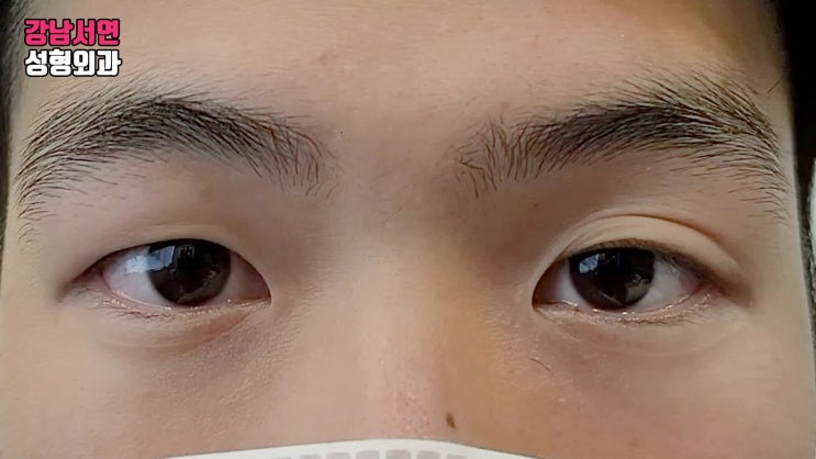 남자 무쌍 눈매교정 붓기 , 쌍꺼풀 없애기 붓기, 무쌍쌍꺼풀 수술 치험례