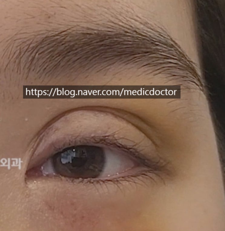 쌍수 조기교정 쌍꺼풀 조기재수술 증례
