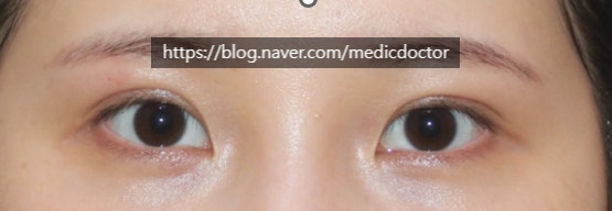 두줄따기 수술 증례 알아보자