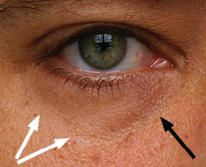 눈밑지방재배치 수술 , 눈밑불룩, 다크써클개선