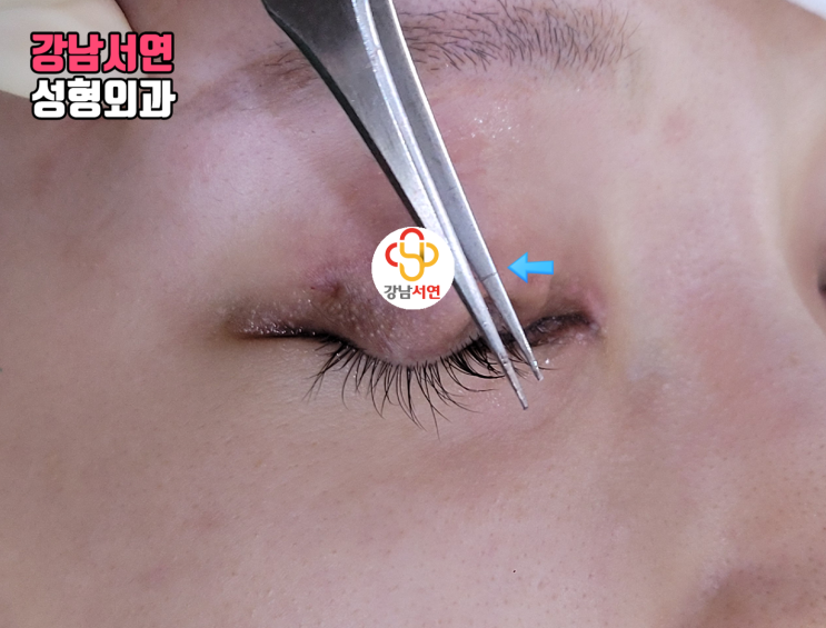자연유착 실제거 자연유착 풀기