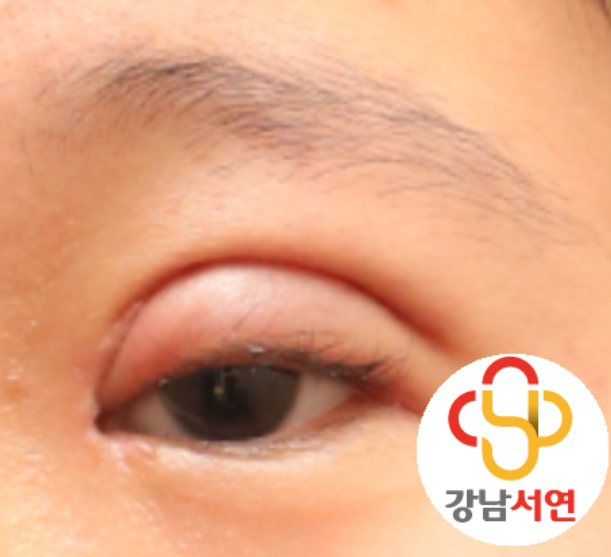 두줄따기(?) 수술을 하지 말라고?? 두줄따기 수술은 하면 안되는 수술?