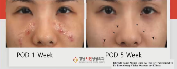 눈밑지방재배치 강의 EZ-Tcon 웨비나(webinar) 한스바이오메드 협찬 (다크써클, 눈밑지방, 하안검)