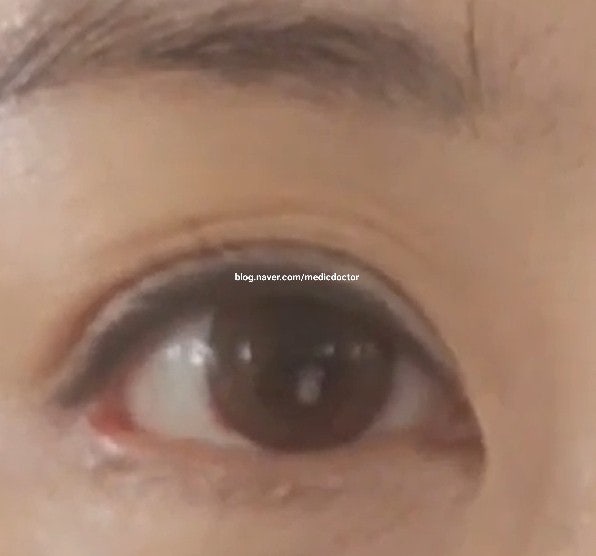 두줄따기 붓기 (feat. 부기로 인한 미세주름)