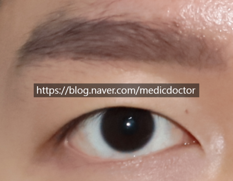 남자무쌍눈매교정, 남자무쌍(속쌍)수술